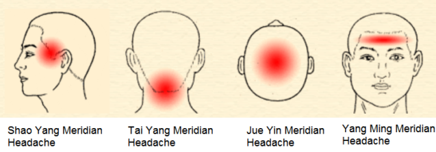 Differentiation of the affected meridians based on the headache spots